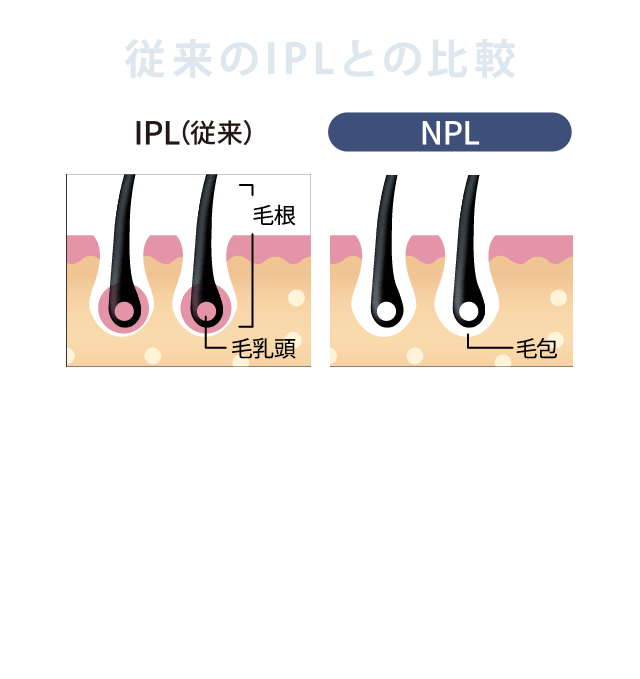 従来のIPLとの比較
